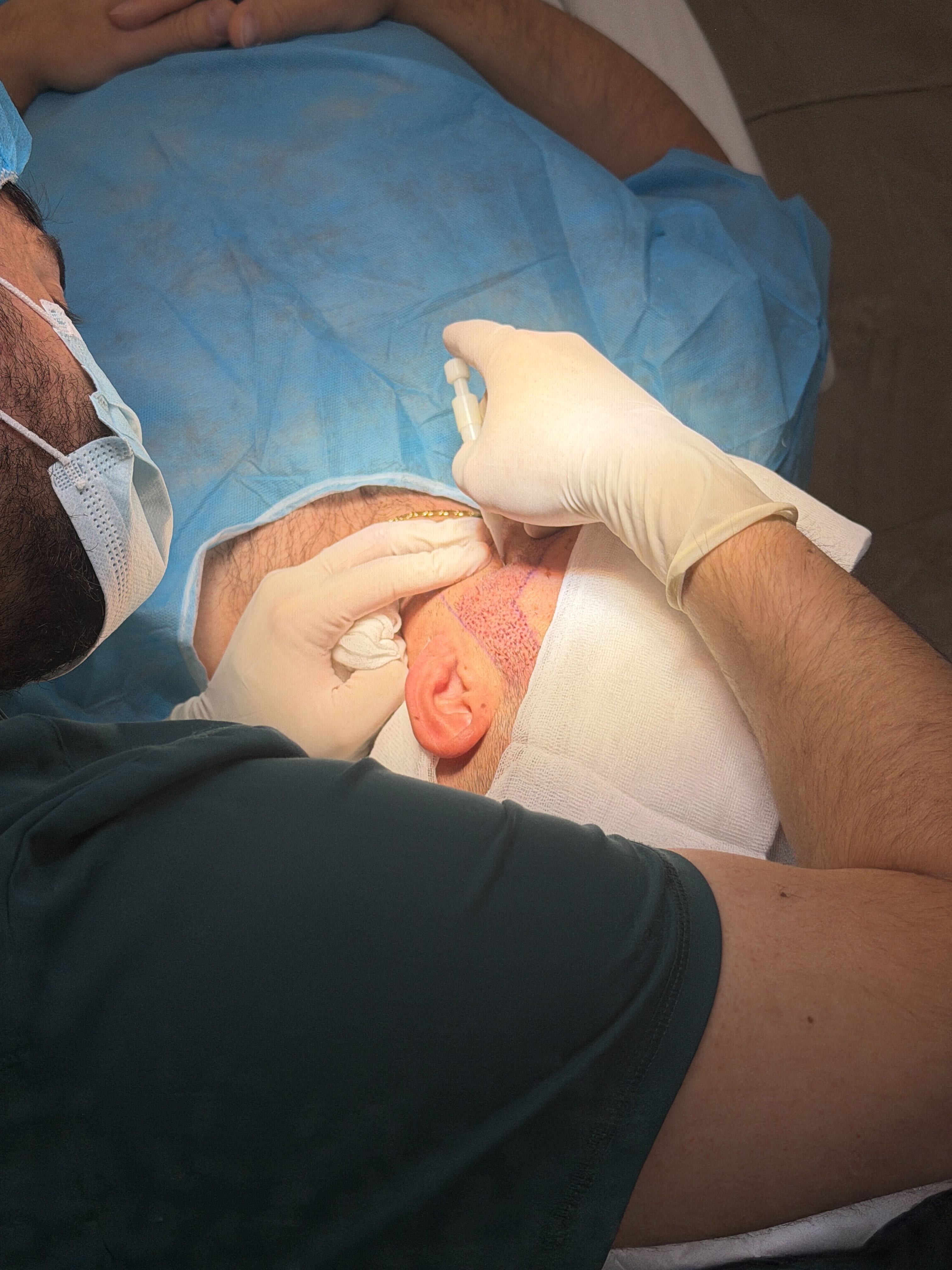 Trajtimi i cikatriceve me transplant mjekre